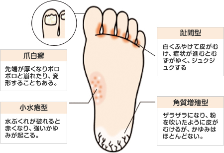 爪白癬　小水疱型　趾間型　角質増殖型